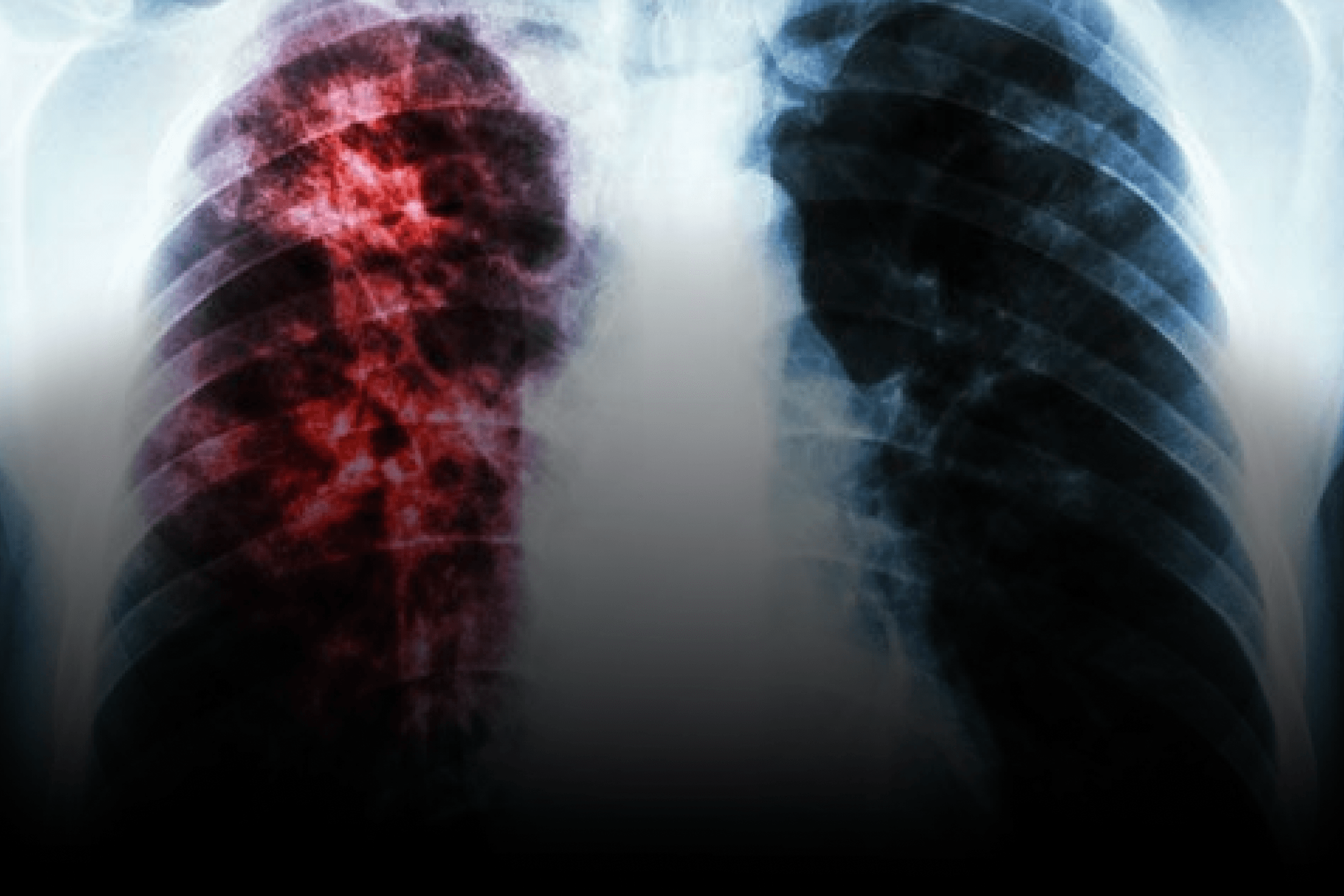 Novo antibiótico supera tuberculose resistente